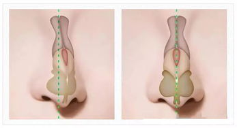 歪鼻整形手术,歪鼻整形手术——重塑鼻部轮廓，重拾自信笑容(图3)