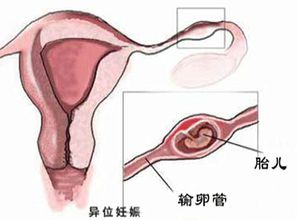 宫外孕手术,宫外孕手术——了解手术流程、方式及费用(图3)