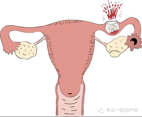 宫外孕手术,宫外孕手术——了解手术流程、方式及费用(图5)