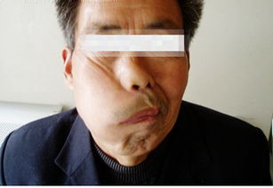 治面瘫游戏,趣味游戏助力面瘫康复之旅(图1) 治面瘫游戏,趣味游戏助力面瘫康复之旅(图1)