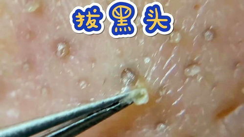 拔黑头游戏,拔黑头游戏大揭秘(图2)