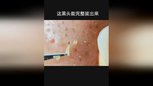 拔黑头游戏,拔黑头游戏大揭秘(图3)