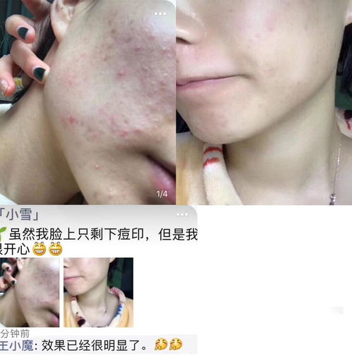 游戏消痘痘,畅享游戏乐趣(图1) 游戏消痘痘,畅享游戏乐趣(图1)