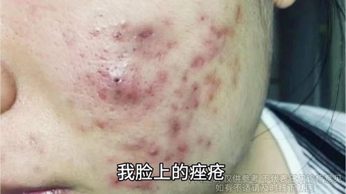 游戏消痘痘,畅享游戏乐趣(图2) 游戏消痘痘,畅享游戏乐趣(图2)