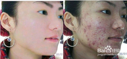游戏消痘痘,畅享游戏乐趣(图3) 游戏消痘痘,畅享游戏乐趣(图3)