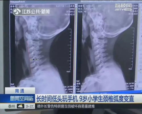 玩颈椎游戏,告别颈肩酸痛(图1) 玩颈椎游戏,告别颈肩酸痛(图1)